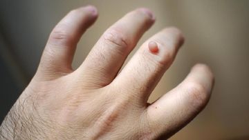 Bahaya HPV: Infeksi Tak Cuma di Kelamin, Bisa Picu Kutil di Tangan
